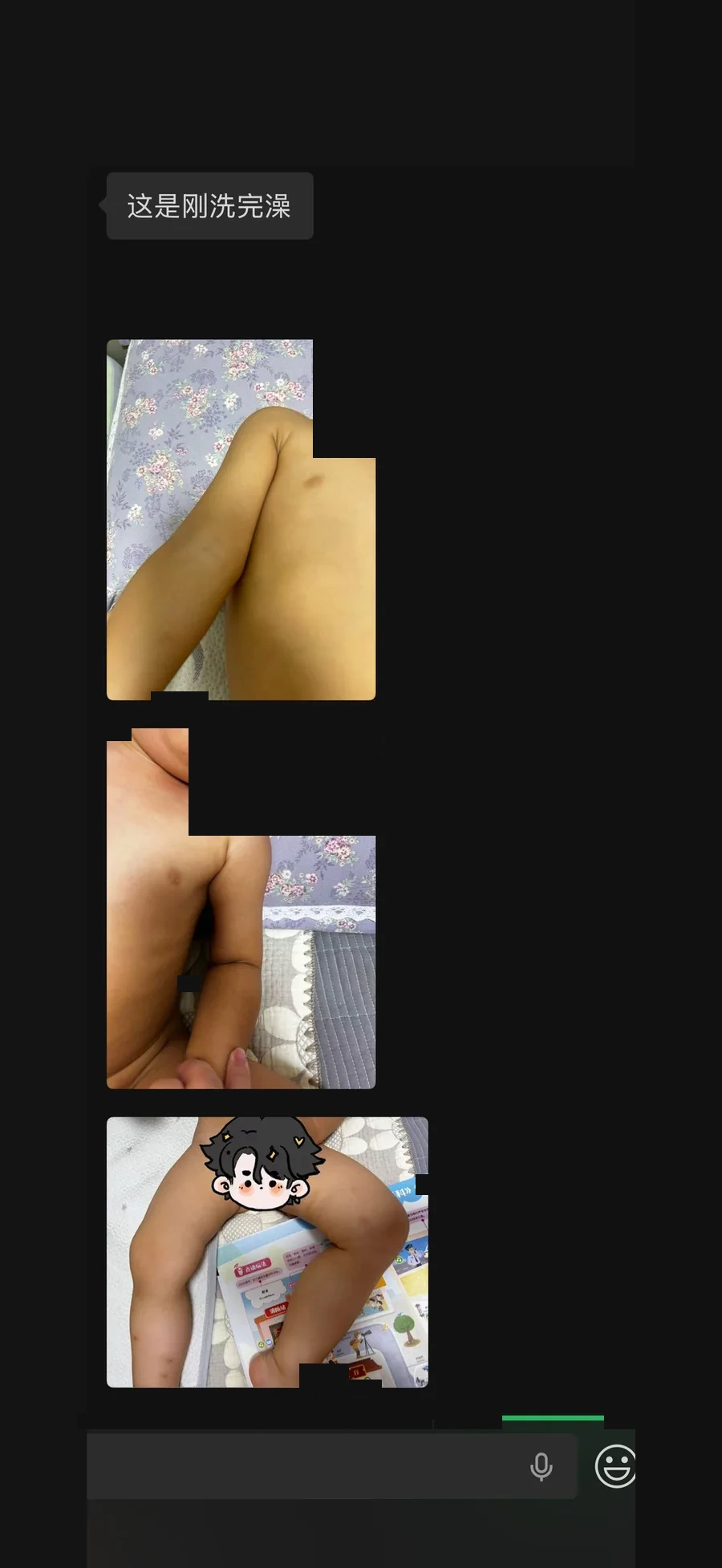 慢性荨麻疹案例后续阶段照片，可识别面部已处理