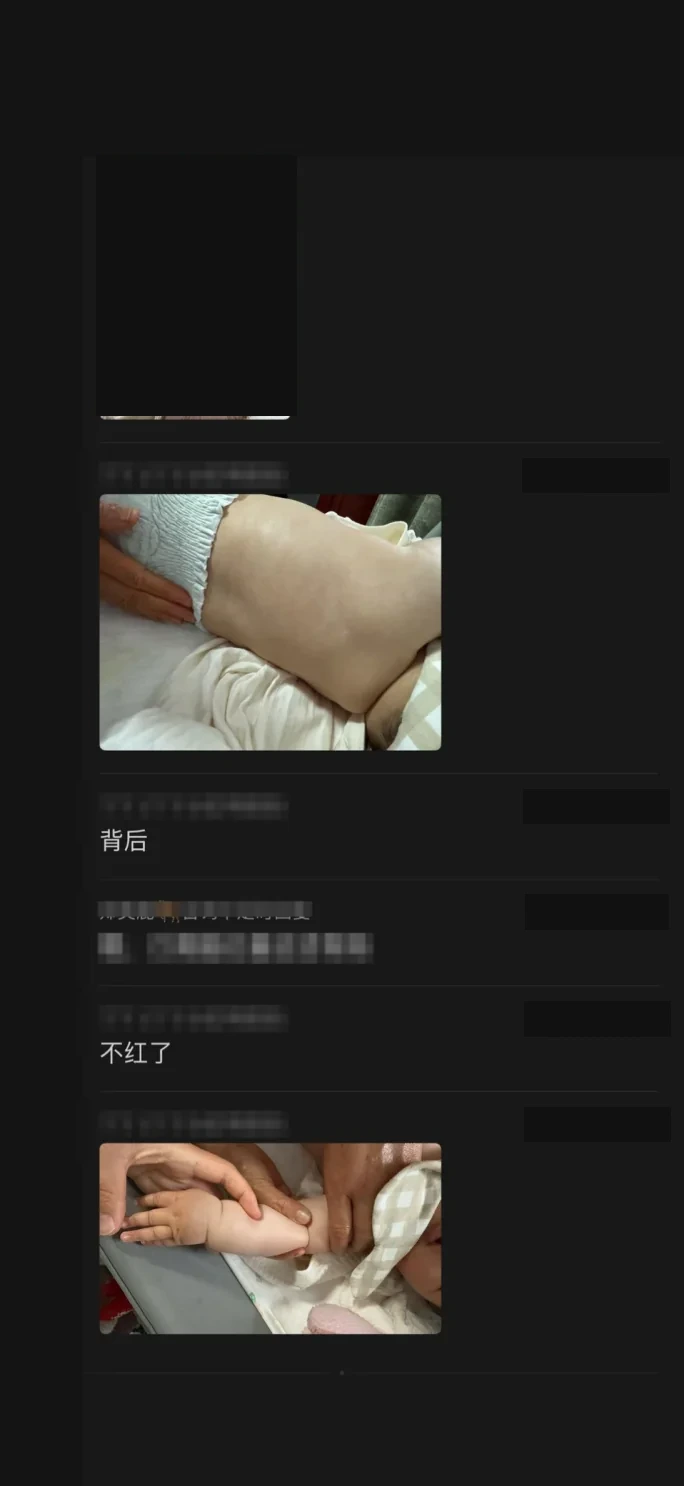 母乳期湿疹宝宝阶段照片，可识别面部已处理