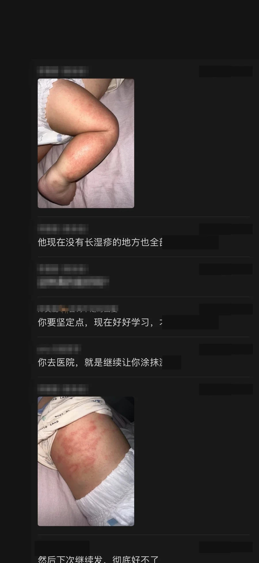 严重湿疹案例皮肤照片与沟通记录，身份信息已处理
