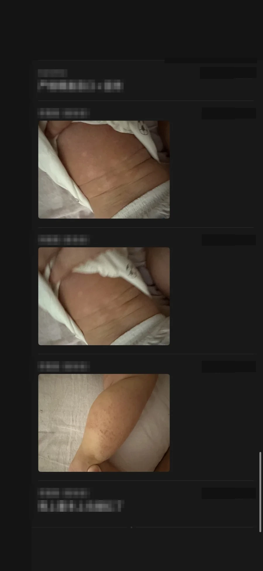 严重湿疹案例阶段皮肤照片