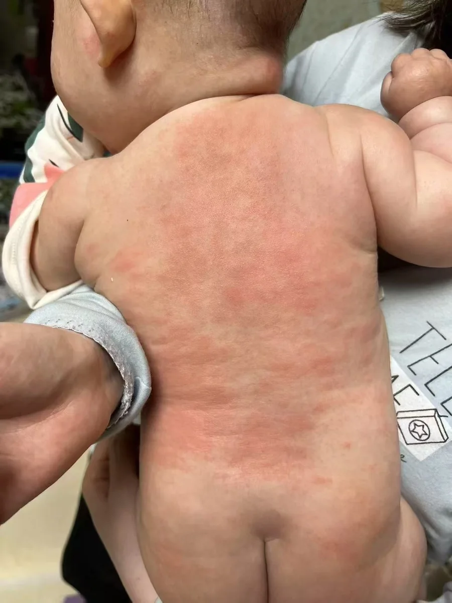 菌群检测案例身体状态阶段照片
